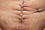 op, operation, abdomen surgery