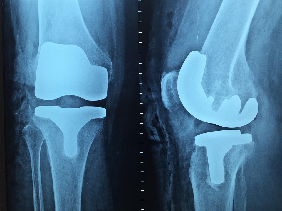 Læge, Ortopædi, Xray, Knæ