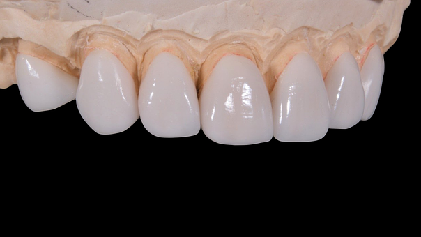 Free Dental Porcelain Tooth illustration and picture