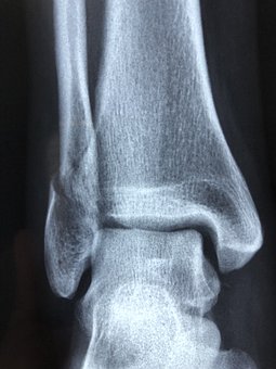 Why is my sprained ankle not getting better? 2 Radiography, Diagnosis, Anatomy, Injury