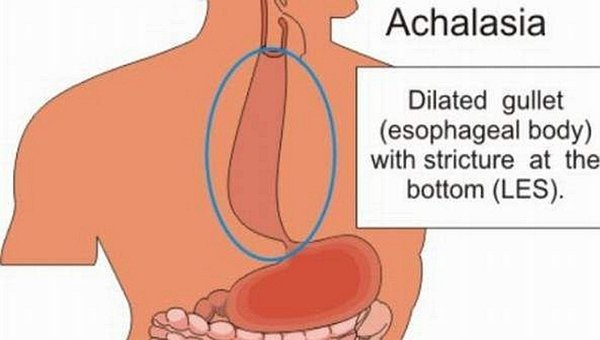 La Acalasia, ¿Cuál Es La Acalasia