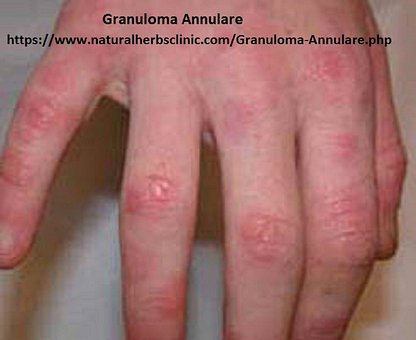 El Granuloma Anular