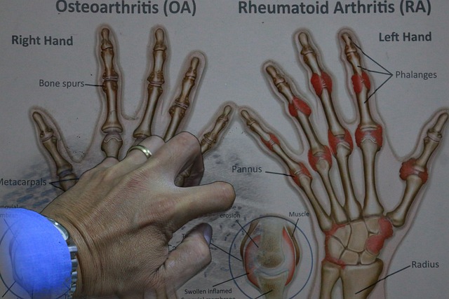 Free Arthritis Osteoarthritis photo and picture