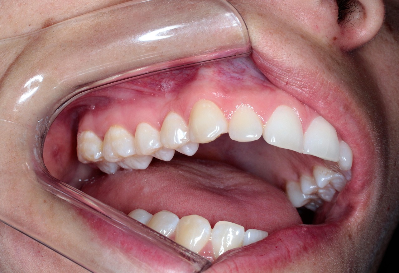Embouchure Anesthésie Photo gratuite sur Pixabay Pixabay