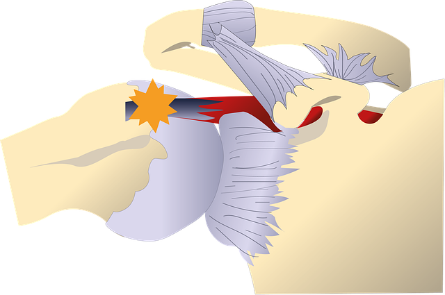 Tendinitis, Hombro, Glenohumeral