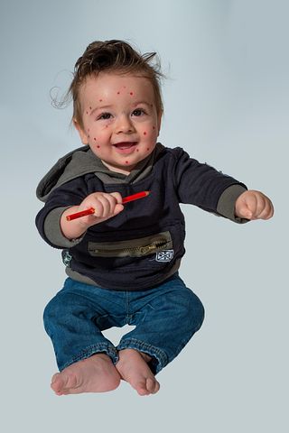 1以上の無料水疱瘡 男の子画像