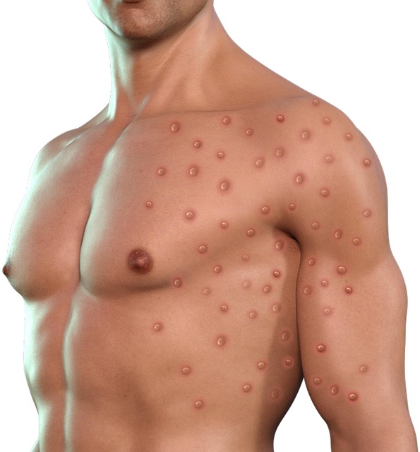 Free monkeypox monkeypox virus virus illustration