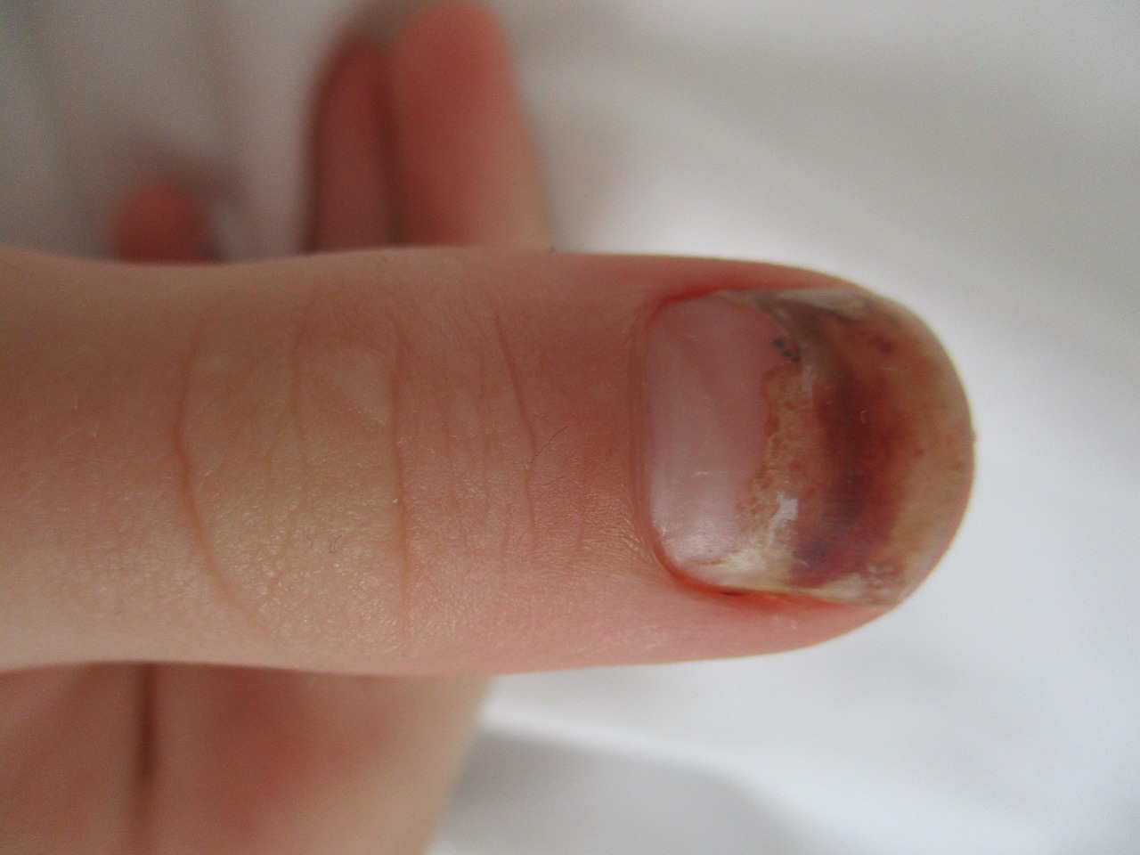 Finger In Tür Eingeklemmt Nagel Blau Nagel Verletzung Auswachsen - Kostenloses Foto auf Pixabay - Pixabay