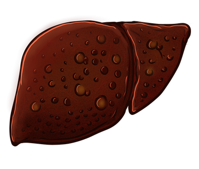 Free Cirrhosis Liver illustration and picture