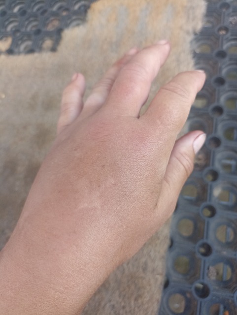 Free Allergy Anaphylactic Shock photo and picture