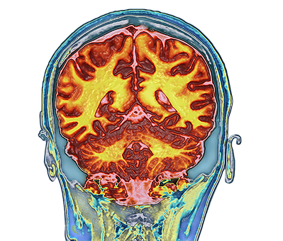 Hjerne, Scanning, Mr, Neurologi