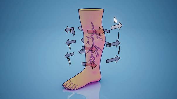 Free Venous Varicose Veins photo and picture