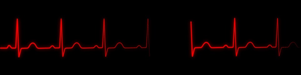 Sinus, Rythm, Heart. Free Stock Video - Pixabay